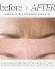 Mandelic Resurfacing Serum 8%